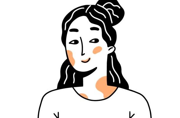 Happy portrait woman with vitiligo. Female character with pigmentation. Vector illustration in linear doodle style.